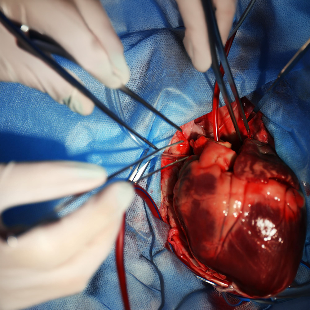 Atrial Septal Defect (ASD) Closure