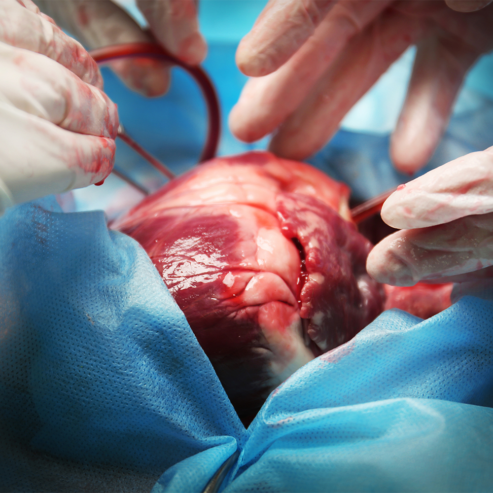 Cardiac Tumour Removal Surgery