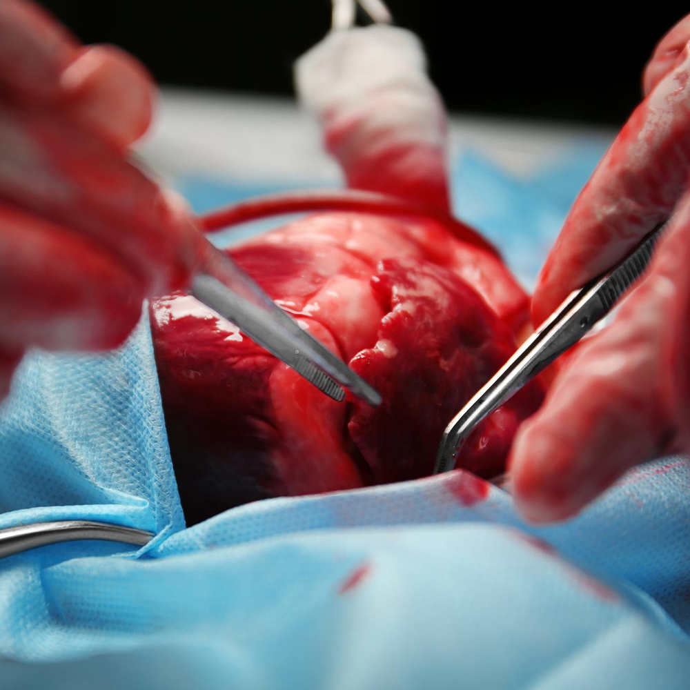 EPS & RFA Procedure