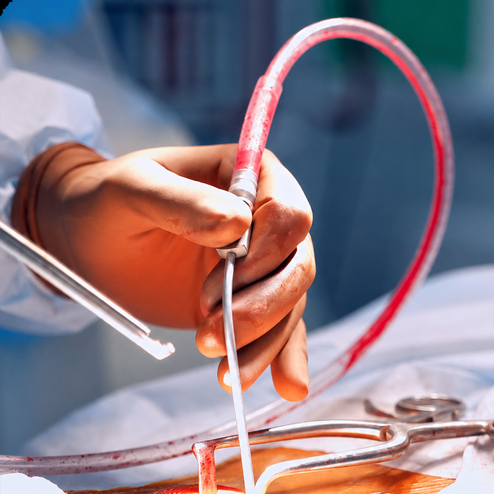 Angioplasty & Stent