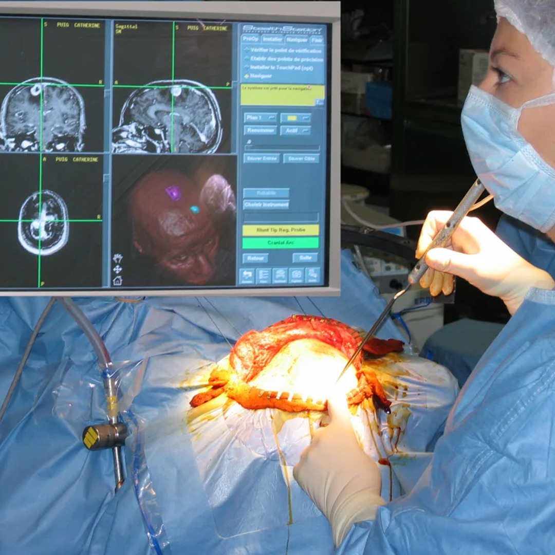 Brain Tumor Neuronavigation Surgery