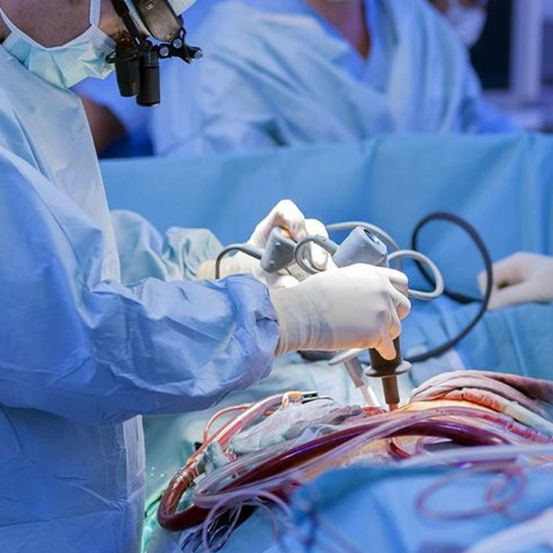 Open Bypass Surgery