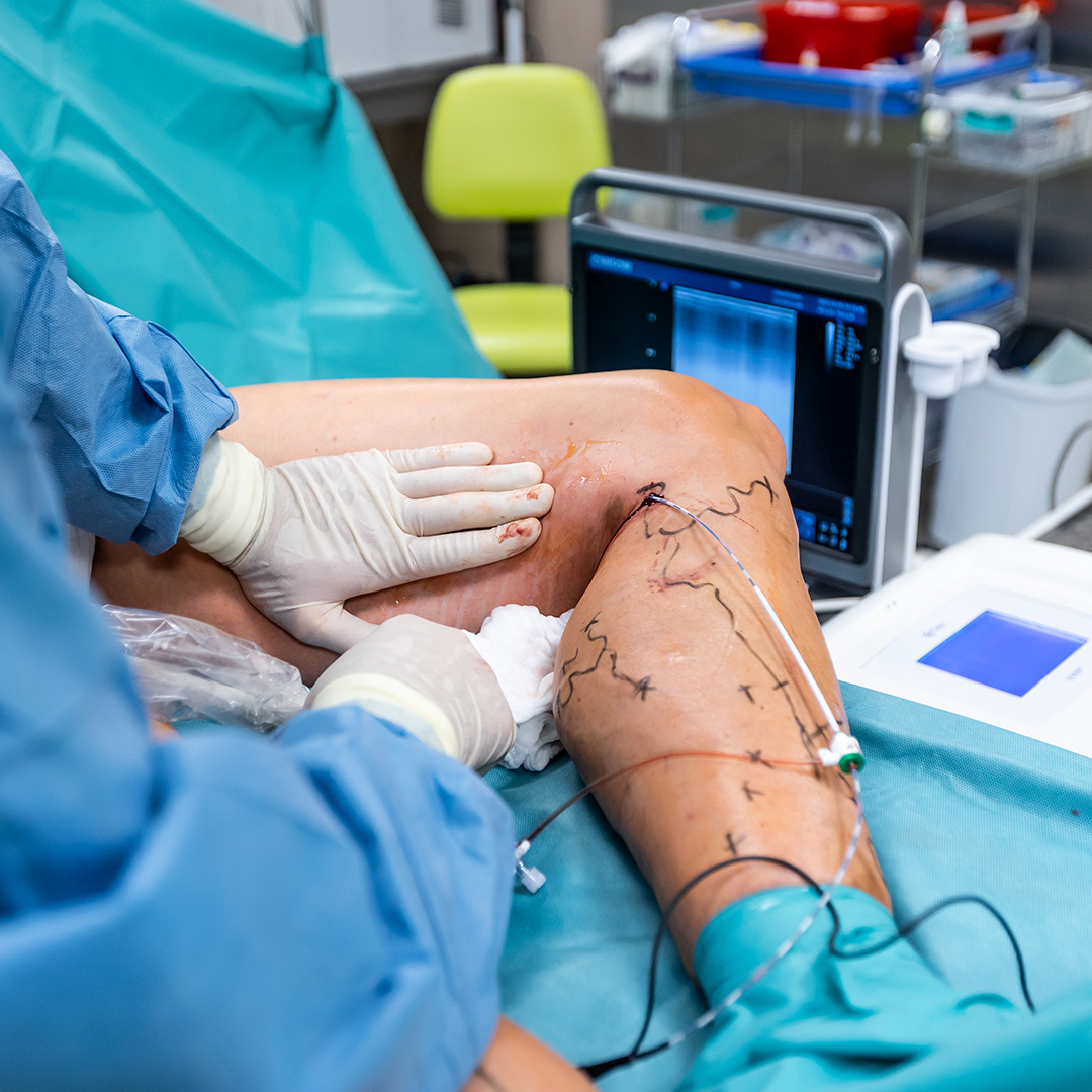 Phlebectomy
